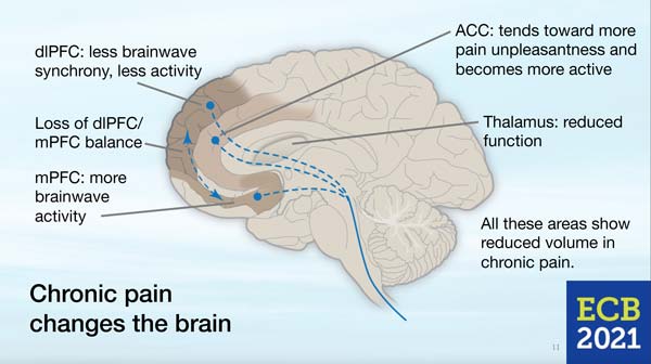 songrest-pain-changes-brain.jpg